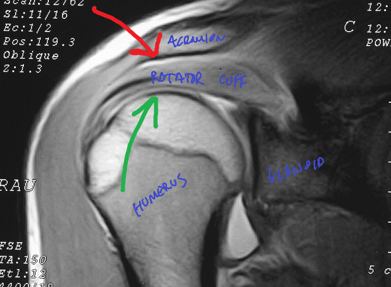The Difference Between External and Internal Impingement of the